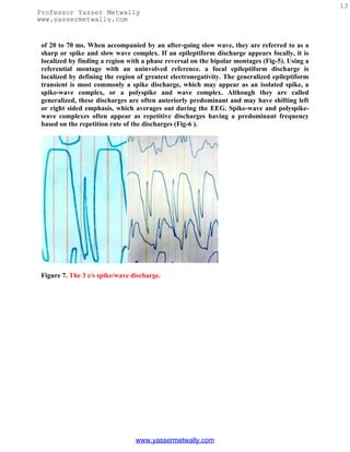 13
Professor Yasser Metwally
www.yassermetwally.com


 of 20 to 70 ms. When accompanied by an after-going slow wave, they are referred to as a
 sharp or spike and slow wave complex. If an epileptiform discharge appears focally, it is
 localized by finding a region with a phase reversal on the bipolar montages (Fig-5). Using a
 referential montage with an uninvolved reference. a focal epileptiform discharge is
 localized by defining the region of greatest electronegativity. The generalized epileptiform
 transient is most commonly a spike discharge, which may appear as an isolated spike, a
 spike-wave complex, or a polyspike and wave complex. Although they are called
 generalized, these discharges are often anteriorly predominant and may have shifting left
 or right sided emphasis, which averages out during the EEG. Spike-wave and polyspike-
 wave complexes often appear as repetitive discharges having a predominant frequency
 based on the repetition rate of the discharges (Fig-6 ).




 Figure 7. The 3 c/s spike/wave discharge.




                                 www.yassermetwally.com
 