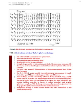 14
Professor Yasser Metwally
www.yassermetwally.com




 Figure 8. The Frontally predominant 3 c/s spike/wave discharge.

 Table 1. Electroclinical criteria of the 3 c/s spike/wave discharge

           It is bilateral fairly symmetrical and synchronous.
           It has a frontal midline maximum.
           It has a sudden onset and sudden offset.
           Readily activated by hyperventilation.
           It might be proceeded by intermittent, rhythmic, bisynchronous monomorphic
            slow waves in the occipital regions (occipital intermittent rhythmic delta activity
            OIRDA).
           The 3 c/s SWD is usually associated with an ictal absence episode when it lasts
            over 5 seconds.
           The 3 c/s SWD is an age specific electrophysiological phenomenon. It usually
            start at the age of 3.5 years and disappear at the age of 16 years.
           This discharge pattern is markedly enhanced during nonREM sleep, usually
            during stage II. However the morphological features of this discharge pattern
            are altered during sleep with the discharge occurring in a more fragmented and
            atypical fashion, occurring in bursts of spikes, polyspikes and atypical
            spike/wave complexes. This discharge pattern usually occurs in conjunction with
            sleep spindles and has an invariable frontal midline maximum.
           Background activity is within normal before and after termination of the
            paroxysmal discharge.




                                  www.yassermetwally.com
 