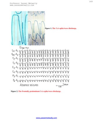 169
Professor Yasser Metwally
www.yassermetwally.com




                                           Figure 1. The 3 c/s spike/wave discharge.




 Figure 2. The Frontally predominant 3 c/s spike/wave discharge.




                                www.yassermetwally.com
 