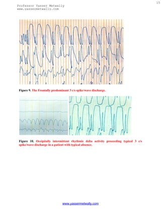 15
Professor Yasser Metwally
www.yassermetwally.com




 Figure 9. The Frontally predominant 3 c/s spike/wave discharge.




 Figure 10. Occipitally intermittent rhythmic delta activity proceeding typical 3 c/s
 spike/wave discharge in a patient with typical absence.




                                www.yassermetwally.com
 