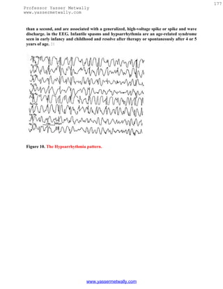 177
Professor Yasser Metwally
www.yassermetwally.com


 than a second, and are associated with a generalized, high-voltage spike or spike and wave
 discharge. in the EEG. Infantile spasms and hypsarrhythmia are an age-related syndrome
 seen in early infancy and childhood and resolve after therapy or spontaneously after 4 or 5
 years of age. 21




 Figure 10. The Hypsarrhythmia pattern.




                                 www.yassermetwally.com
 