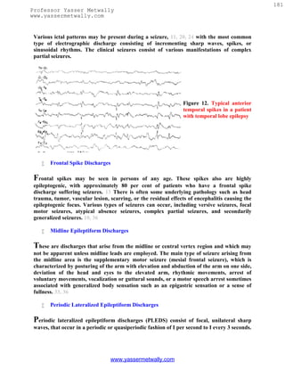 181
Professor Yasser Metwally
www.yassermetwally.com


 Various ictal patterns may be present during a seizure, 11, 20, 24 with the most common
 type of electrographic discharge consisting of incrementing sharp waves, spikes, or
 sinusoidal rhythms. The clinical seizures consist of various manifestations of complex
 partial seizures.




                                                                 Figure 12. Typical anterior
                                                                 temporal spikes in a patient
                                                                 with temporal lobe epilepsy




       Frontal Spike Discharges

 Frontal   spikes may be seen in persons of any age. These spikes also are highly
 epileptogenic, with approximately 80 per cent of patients who have a frontal spike
 discharge suffering seizures. 13 There is often some underlying pathology such as head
 trauma, tumor, vascular lesion, scarring, or the residual effects of encephalitis causing the
 epileptogenic focus. Various types of seizures can occur, including versive seizures, focal
 motor seizures, atypical absence seizures, complex partial seizures, and secondarily
 generalized seizures. 10, 36

       Midline Epileptiform Discharges

 These are discharges that arise from the midline or central vertex region and which may
 not be apparent unless midline leads are employed. The main type of seizure arising from
 the midline area is the supplementary motor seizure (mesial frontal seizure), which is
 characterized by posturing of the arm with elevation and abduction of the arm on one side,
 deviation of the head and eyes to the elevated arm, rhythmic movements, arrest of
 voluntary movements, vocalization or guttural sounds, or a motor speech arrest sometimes
 associated with generalized body sensation such as an epigastric sensation or a sense of
 fullness. 33, 36

       Periodic Lateralized Epileptiform Discharges

 Periodic  lateralized epileptiform discharges (PLEDS) consist of focal, unilateral sharp
 waves, that occur in a periodic or quasiperiodic fashion of I per second to I every 3 seconds.




                                   www.yassermetwally.com
 