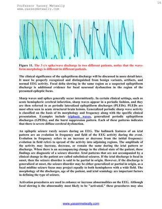 16
Professor Yasser Metwally
www.yassermetwally.com




 Figure 11. The 3 c/s spike/wave discharge in two different patients, notice that the wave-
 form morphology is different in different patients.

 The clinical significance of the epileptiform discharge will be discussed in more detail later.
 It must be properly recognized and distinguished from benign variants, artifacts, and
 normal EEG activity. Focal delta slowing in the same region as a suspected epileptiform
 discharge is additional evidence for focal neuronal dysfunction in the region of the
 presumed epileptic focus.

 Sharp waves and spikes generally occur intermittently. In certain clinical settings, such as
 acute hemispheric cerebral infarction, sharp waves appear in a periodic fashion, and they
 are then referred to as periodic lateralized epileptiform discharges (PLEDs). PLEDs are
 most often seen in acute structural brain lesions. Generalized periodic sharp wave activity
 is classified on the basis of its morphology and frequency along with the specific clinical
 presentation. Examples include triphasic waves, generalized periodic epileptiform
 discharges (GPEDs), and the burst suppression pattern. Each of these patterns indicates
 that there is severe diffuse cerebral dysfunction.

 An epileptic seizure rarely occurs during an EEG. The hallmark features of an ictal
 pattern are an evolution in frequency and field of the EEG activity during the event.
 Evolution in frequency refers to an increase or decrease from the initial frequency:
 evolution in field refers to spread of the activity into adjoining regions. The amplitude of
 the activity may increase, decrease, or remain the same during the ictal pattern or
 discharge. When there is an accompanying change in the clinical state of the patient, these
 findings are diagnostic of a seizure disorder. Ictal patterns that are not accompanied by a
 clinical change in the patient are called subclinical seizures. If the ictal discharge is focal in
 onset, then the seizure disorder is said to be partial in origin. However, if the discharge is
 generalized at onset, the seizure disorder may be either generalized or partial in origin, as a
 focal midline seizure focus may project equally to both hemispheres with a wide field. The
 morphology of the discharges, age of the patient, and ictal semiology are important factors
 in defining the type of seizure.

 Activation procedures are used to enhance or increase abnormalities on the EEG. Although
 focal slowing is the abnormality most likely to be "activated," these procedures may also




                                   www.yassermetwally.com
 