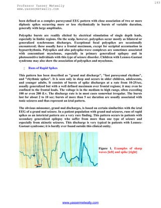 193
Professor Yasser Metwally
www.yassermetwally.com


 been defined as a complex paroxysmal EEG pattern with close association of two or more
 diphasic spikes occurring more or less rhythmically in bursts of variable duration,
 generally with large amplitudes.

 Polyspike bursts are readily elicited by electrical stimulation of single depth leads,
 especially in limbic regions. On the scalp, however, polyspikes occur mostly as bilateral or
 generalized synchronous discharges. Exceptional focal polyspikes are occasionally
 encountered; these usually have a frontal maximum, except for occipital accentuation in
 hypsarrhythmia. Polyspikes and also polyspike-wave complexes are sometimes associated
 with concomitant myoclonus, especially in primary generalized epilepsy and in
 photosensitive individuals with this type of seizure disorder. Children with Lennox-Gastaut
 syndrome may also show the association of polyspikes and myoclonus.

       Runs of Rapid Spikes

 This pattern has been described as "grand mal discharge", "fast paroxysmal rhythms",
 and "rhythmic spikes". It is seen only in sleep and occurs in older children, adolescents,
 and younger adults. It consists of bursts of spike discharges at a rate from 10-25/sec,
 usually generalized but with a well defined maximum over frontal regions; it may even be
 confined to the frontal leads. The voltage is in the medium to high range, often exceeding
 100 or even 200 iLv. The discharge rate is in most cases somewhat irregular. The bursts
 last for about 2 to 10 sec; bursts of more than 5 sec duration are usually associated with
 tonic seizures and thus represent an ictal pattern.

 The obvious misnomer, grand mal discharges, is based on certain similarities with the ictal
 EEG of a grand mal seizure. In a patient population with grand mal seizures, runs of rapid
 spikes as an interictal pattern are a very rare finding. This pattern occurs in patients with
 secondary generalized epilepsy who suffer from more than one type of seizure and
 especially from akinetic seizures. This discharge is very typical in patients with Lennox-
 Gastaut syndrome; it is hardly ever found outside this clinical entity.




                                                             Figure 1. Examples of sharp
                                                             waves [left] and spike [right]




                                 www.yassermetwally.com
 