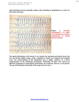 196
Professor Yasser Metwally
www.yassermetwally.com


 spike discharges become gradually smaller, often shrinking to insignificance as well as in
 drowsiness and sleep.




                                                                Figure     3.    Frontally
                                                                predominant 3 c/s spike/
                                                                wave discharge in a patient
                                                                complaining of typical
                                                                absence episodes




 The spatial distribution of the bursts is very typical; the maximum practically always lies
 over the frontal midline region, while a minimum is found over temporal and occipital
 areas. The understanding of this distribution type is highly conducive to a better
 comprehension of the underlying mechanisms. Practically all spike wave bursts are
 bilateral synchronous or generalized synchronous; the synchrony, however, is not perfect.
 The age of distribution is markedly in the range from 4 to 16 yr.




                                 www.yassermetwally.com
 