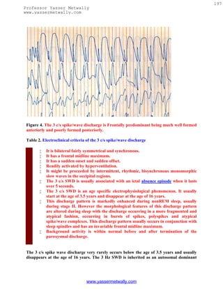 197
Professor Yasser Metwally
www.yassermetwally.com




 Figure 4. The 3 c/s spike/wave discharge is Frontally predominant being much well formed
 anteriorly and poorly formed posteriorly.

 Table 2. Electroclinical criteria of the 3 c/s spike/wave discharge

           It is bilateral fairly symmetrical and synchronous.
           It has a frontal midline maximum.
           It has a sudden onset and sudden offset.
           Readily activated by hyperventilation.
           It might be proceeded by intermittent, rhythmic, bisynchronous monomorphic
            slow waves in the occipital regions.
           The 3 c/s SWD is usually associated with an ictal absence episode when it lasts
            over 5 seconds.
           The 3 c/s SWD is an age specific electrophysiological phenomenon. It usually
            start at the age of 3.5 years and disappear at the age of 16 years.
           This discharge pattern is markedly enhanced during nonREM sleep, usually
            during stage II. However the morphological features of this discharge pattern
            are altered during sleep with the discharge occurring in a more fragmented and
            atypical fashion, occurring in bursts of spikes, polyspikes and atypical
            spike/wave complexes. This discharge pattern usually occurs in conjunction with
            sleep spindles and has an invariable frontal midline maximum.
           Background activity is within normal before and after termination of the
            paroxysmal discharge.


 The 3 c/s spike wave discharge very rarely occurs below the age of 3.5 years and usually
 disappears at the age of 16 years. The 3 Hz SWD is inherited as an autosomal dominant




                                  www.yassermetwally.com
 