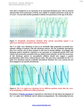 198
Professor Yasser Metwally
www.yassermetwally.com


 trait and is considered as an expression of an autosomal dominant gene with an unusual
 characteristic of low penetrance at birth, rises rapidly to complete penetrance at the age of
 3.5 years - 16 years then decline gradually to almost zero penetrance at the age of 40 years.




 Figure 5. Occipitally intermittent rhythmic delta activity proceeding typical 3 c/s
 spike/wave discharge in a patient with typical absence.

 The 3 c/s spike wave discharge is seen in an unusually high proportion of normal non-
 epileptic siblings of patients with this discharge pattern, also the occipitally intermittent
 slow wave activity seen in those patients is also seen in normal siblings. Accordingly this
 discharge pattern should be regarded as an expression of a dominant genetic EEG trait
 which is not necessarily associated with any clinical seizure disorder. In fact the occurrence
 of this discharge pattern in non-epileptic children should only suggest a genetic
 predisposition rather than a clinical disease entity. The gene locus responsible for the 3 c/s
 spike wave discharge and the occipitally intermittent rhythmic slow wave activity has not
 been mapped to any specific chromosome.




 Figure 6. The 3 c/s spike/wave discharge in two different patients, notice that the wave-
 form morphology is different in different patients.

 Past history of febrile convulsion is regarded as a risk factors for the future development of
 the 3 c/s spike wave discharge and its clinical accompaniment. The relationship between




                                  www.yassermetwally.com
 