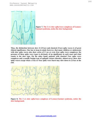 200
Professor Yasser Metwally
www.yassermetwally.com




                                 Figure 7. The 2 c/s slow spike/wave complexes of Lennox-
                                 Gastaut syndrome, notice the slow background.




 Thus, the distinction between slow (1-2.5/sec) and classical (3/sec) spike waves is of great
 clinical significance. One has to keep in mind, however, that many children or adolescents
 with slow spike waves also show series of 3/ see or even 4/sec spike wave complexes; the
 presence of these spike wave types is obviously of no significance in such cases and what
 counts is the slow type. On the other hand, patients with classical 3/sec spike wave
 complexes and a usually benign type of epileptic seizure disorder, almost never show slow
 spike waves except when a 3/sec or 4/sec spike wave burst may slow down to 2.5/sec at the
 end.




 Figure 8. The 2 c/s slow spike/wave complexes of Lennox-Gastaut syndrome, notice the
 slow background.




                                 www.yassermetwally.com
 