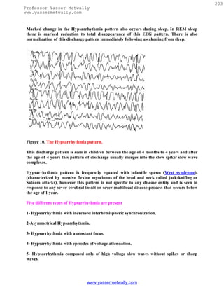 203
Professor Yasser Metwally
www.yassermetwally.com


 Marked change in the Hypsarrhythmia pattern also occurs during sleep. In REM sleep
 there is marked reduction to total disappearance of this EEG pattern. There is also
 normalization of this discharge pattern immediately following awakening from sleep.




 Figure 10. The Hypsarrhythmia pattern.

 This discharge pattern is seen in children between the age of 4 months to 4 years and after
 the age of 4 years this pattern of discharge usually merges into the slow spike/ slow wave
 complexes.

 Hypsarrhythmia pattern is frequently equated with infantile spasm (West syndrome),
 (characterized by massive flexion myoclonus of the head and neck called jack-knifing or
 Salaam attacks), however this pattern is not specific to any disease entity and is seen in
 response to any sever cerebral insult or sever multifocal disease process that occurs below
 the age of 1 year.

 Five different types of Hypsarrhythmia are present

 1- Hypsarrhythmia with increased interhemispheric synchronization.

 2-Asymmetrical Hypsarrhythmia.

 3- Hypsarrhythmia with a constant focus.

 4- Hypsarrhythmia with episodes of voltage attenuation.

 5- Hypsarrhythmia composed only of high voltage slow waves without spikes or sharp
 waves.




                                 www.yassermetwally.com
 