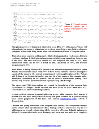 218
Professor Yasser Metwally
www.yassermetwally.com




                                                                 Figure 1. Typical anterior
                                                                 temporal spikes in a
                                                                 patient with temporal lobe
                                                                 epilepsy




 The spike (sharp wave) discharge is bilateral in about 25 to 35% of the cases. Patients with
 bilateral anterior temporal spikes (sharp waves) are more likely to have both psychomotor
 and grand mal seizures. Sleep has an important role in the facilitation of temporal spikes.

 Bilateral anterior temporal spiking may be bilateral independent or synchronous. Bilateral
 synchrony has been divided into real synchrony and discharges transmitted from one side
 to the other. The spike discharge occurs over one temporal lobe only in 34%, while
 transmission from side to side is noted in 24%, synchrony in 19%, and bilateral
 independence in 23%.

 Brain tumor is rarely discovered in patients with bilateral independent temporal spikes.
 Patients with unilateral spikes often prove to have mesial temporal sclerosis; the superior
 aspects of the temporal lobe showed a maximum of corticographic spike activity. Patients
 with lesions of the basomesial surface and the tip of the temporal lobe revealed spikes
 transmitted secondarily to the opposite side or bilateral synchronous spiking. These
 patients may show less prominent or even equivocal scalp EEG findings.

 The paroxysmal EEG abnormalities may exceed the boundaries of the temporal lobe.
 Psychomotor or complex partial seizures are more likely to occur when focal EEG
 abnormalities are limited to the temporal lobe.

 In some patients, anterior temporal spikes are scanty, while consistent focal slowing is
 present over this area. This pattern is usually not good evidence for a space-occupying
 lesion unless progression of the focal slow (mainly polymorphic delta) activity is
 demonstrable.

 Children and young adolescents with temporal lobe epilepsy and unequivocal complex
 partial seizures often have inconclusive EEG findings. Spikes or sharp waves may be over
 midtemporal or central regions (thus falsely suggestive of benign Rolandic epilepsy) or
 diffuse. Even generalized spike wave discharges may occur and slow spike wave complexes




                                 www.yassermetwally.com
 