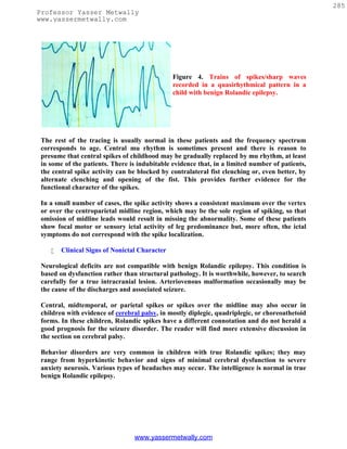 285
Professor Yasser Metwally
www.yassermetwally.com




                                               Figure 4. Trains of spikes/sharp waves
                                               recorded in a quasirhythmical pattern in a
                                               child with benign Rolandic epilepsy.




 The rest of the tracing is usually normal in these patients and the frequency spectrum
 corresponds to age. Central mu rhythm is sometimes present and there is reason to
 presume that central spikes of childhood may be gradually replaced by mu rhythm, at least
 in some of the patients. There is indubitable evidence that, in a limited number of patients,
 the central spike activity can be blocked by contralateral fist clenching or, even better, by
 alternate clenching and opening of the fist. This provides further evidence for the
 functional character of the spikes.

 In a small number of cases, the spike activity shows a consistent maximum over the vertex
 or over the centroparietal midline region, which may be the sole region of spiking, so that
 omission of midline leads would result in missing the abnormality. Some of these patients
 show focal motor or sensory ictal activity of leg predominance but, more often, the ictal
 symptoms do not correspond with the spike localization.

       Clinical Signs of Nonictal Character

 Neurological deficits are not compatible with benign Rolandic epilepsy. This condition is
 based on dysfunction rather than structural pathology. It is worthwhile, however, to search
 carefully for a true intracranial lesion. Arteriovenous malformation occasionally may be
 the cause of the discharges and associated seizure.

 Central, midtemporal, or parietal spikes or spikes over the midline may also occur in
 children with evidence of cerebral palsy, in mostly diplegic, quadriplegic, or choreoathetoid
 forms. In these children, Rolandic spikes have a different connotation and do not herald a
 good prognosis for the seizure disorder. The reader will find more extensive discussion in
 the section on cerebral palsy.

 Behavior disorders are very common in children with true Rolandic spikes; they may
 range from hyperkinetic behavior and signs of minimal cerebral dysfunction to severe
 anxiety neurosis. Various types of headaches may occur. The intelligence is normal in true
 benign Rolandic epilepsy.




                                 www.yassermetwally.com
 