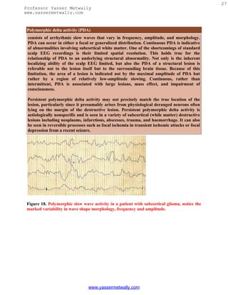 27
Professor Yasser Metwally
www.yassermetwally.com


 Polymorphic delta activity (PDA)
 consists of arrhythmic slow waves that vary in frequency, amplitude, and morphology.
 PDA can occur in either a focal or generalized distribution. Continuous PDA is indicative
 of abnormalities involving subcortical white matter. One of the shortcomings of standard
 scalp EEG recordings is their limited spatial resolution. This holds true for the
 relationship of PDA to an underlying structural abnormality. Not only is the inherent
 localizing ability of the scalp EEG limited, but also the PDA of a structural lesion is
 referable not to the lesion itself but to the surrounding brain tissue. Because of this
 limitation, the area of a lesion is indicated not by the maximal amplitude of PDA but
 rather by a region of relatively low-amplitude slowing. Continuous, rather than
 intermittent, PDA is associated with large lesions, mass effect, and impairment of
 consciousness.

 Persistent polymorphic delta activity may not precisely match the true location of the
 lesion, particularly since it presumably arises from physiological deranged neurons often
 lying on the margin of the destructive lesion. Persistent polymorphic delta activity is
 aetiologically nonspecific and is seen in a variety of subcortical (while matter) destructive
 lesions including neoplasms, infarctions, abscesses, trauma, and haemorrhage. It can also
 be seen in reversible processes such as focal ischemia in transient ischemic attacks or focal
 depression from a recent seizure.




 Figure 18. Polymorphic slow wave activity in a patient with subcortical glioma, notice the
 marked variability in wave shape morphology, frequency and amplitude.




                                 www.yassermetwally.com
 
