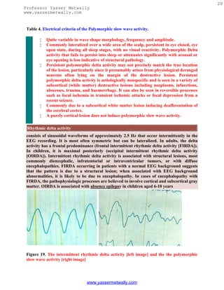 28
Professor Yasser Metwally
www.yassermetwally.com


 Table 4. Electrical criteria of the Polymorphic slow wave activity.

           Quite variable in wave shape morphology, frequency and amplitude.
           Commonly lateralized over a wide area of the scalp, persistent in eye closed, eye
            open state, during all sleep stages, with no visual reactivity. Polymorphic Delta
            activity that fails to persist into sleep or attenuates significantly with arousal or
            eye opening is less indicative of structural pathology.
           Persistent polymorphic delta activity may not precisely match the true location
            of the lesion, particularly since it presumably arises from physiological deranged
            neurons often lying on the margin of the destructive lesion. Persistent
            polymorphic delta activity is aetiologically nonspecific and is seen in a variety of
            subcortical (while matter) destructive lesions including neoplasms, infarctions,
            abscesses, trauma, and haemorrhage. It can also be seen in reversible processes
            such as focal ischemia in transient ischemic attacks or focal depression from a
            recent seizure.
           Commonly due to a subcortical white matter lesion inducing deafferentation of
            the cerebral cortex.
           A purely cortical lesion does not induce polymorphic slow wave activity.

 Rhythmic delta activity
 consists of sinusoidal waveforms of approximately 2.5 Hz that occur intermittently in the
 EEG recording. It is most often symmetric but can be lateralized. In adults, the delta
 activity has a frontal predominance (frontal intermittent rhythmic delta activity [FIRDA]).
 In children, it is maximal posteriorly (occipital intermittent rhythmic delta activity
 [OIRDA]). Intermittent rhythmic delta activity is associated with structural lesions, most
 commonly diencephalic, infratentorial or intraventricular tumors, or with diffuse
 encephalopathies. FIRDA occurring in patients with a normal EEG background suggests
 that the pattern is due to a structural lesion; when associated with EEG background
 abnormalities, it is likely to be due to encephalopathy. In cases of encephalopathy with
 FIRDA, the pathophysiologic processes are believed to involve cortical and subcortical gray
 matter. OIRDA is associated with absence epilepsy in children aged 6-10 years




 Figure 19. The intermittent rhythmic delta activity [left image] and the the polymorphic
 slow wave activity [right image]




                                  www.yassermetwally.com
 