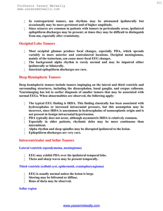 311
Professor Yasser Metwally
www.yassermetwally.com


       In centroparietal tumors, mu rhythms may be attenuated ipsilaterally but
        occasionally may be more persistent and of higher amplitude.
       Since seizures are common in patients with tumors in perirolandic areas, ipsilateral
        epileptiform discharges may be present; at times they may be difficult to distinguish
        from mu, especially after craniotomy.

 Occipital Lobe Tumors

       Most occipital gliomas produce focal changes, especially PDA, which spreads
        variably to more anterior and contralateral locations. Occipital meningiomas,
        mainly of the tentorium, can cause more focal EEG changes.
       The background alpha rhythm is rarely normal and may be impaired either
        ipsilaterally or bilaterally.
       Interictal epileptiform discharges are rare.

 Deep Hemispheric Tumors

 Deep hemispheric tumors include tumors impinging on the lateral and third ventricle and
 surrounding structures, including the diencephalon, basal ganglia, and corpus callosum.
 Neuroimaging has led to earlier diagnosis of smaller tumors that may be associated with
 normal EEGs. When abnormalities are observed, the following apply:

       The typical EEG finding is IRDA. This finding classically has been associated with
        hydrocephalus or increased intracranial pressure, but this assumption may be
        incorrect, since IRDA is uncommon in hydrocephalus of nonneoplastic origin and is
        not present in benign intracranial hypertension.
       PDA typically does not occur, although asymmetric IRDA is relatively common.
       Especially in older patients, rhythmic delta may be more continuous than
        intermittent.
       Alpha rhythm and sleep spindles may be disrupted ipsilateral to the lesion.
       Epileptiform discharges are very rare.

 Intraventricular and Sellar Tumors

 Lateral ventricle (ependymoma, meningioma)

       EEG may exhibit PDA over the ipsilateral temporal lobe.
       Theta and sharp waves may be present temporally.

 Third ventricle (colloid cyst, epidermoid, craniopharyngioma)

       EEG is usually normal unless the lesion is large.
       Slowing may be bifrontal or diffuse.
       Runs of theta may be observed.

 Sellar region




                                 www.yassermetwally.com
 