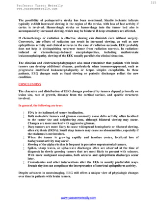 315
Professor Yasser Metwally
www.yassermetwally.com


 The possibility of perioperative stroke has been mentioned. Sizable ischemic infarcts
 typically exhibit increased slowing in the region of the stroke, with loss of fast activity if
 cortex is involved. Hemorrhagic stroke or hemorrhage into the tumor bed also is
 accompanied by increased slowing, which may be bilateral if deep structures are affected.

 If chemotherapy or radiation is effective, slowing can diminish even without surgery.
 Conversely, late effects of radiation can result in increased slowing, as well as new
 epileptiform activity and clinical seizures in the case of radiation necrosis. EEG probably
 does not help in distinguishing recurrent tumor from radiation necrosis. In radiation-
 induced     or   chemotherapy-induced        encephalopathies,     including    methotrexate
 leukoencephalopathy, slowing of the EEG usually parallels the clinical situation.

 The clinician and electroencephalographer also must remember that patients with brain
 tumors can develop additional diseases, particularly when immunosuppressed, such as
 progressive multifocal leukoencephalopathy or herpes simplex encephalitis. In these
 patients, EEG changes such as focal slowing or periodic discharges reflect the new
 condition.

 CONCLUSIONS

 The character and distribution of EEG changes produced by tumors depend primarily on
 lesion size, rate of growth, distance from the cortical surface, and specific structures
 involved.

 In general, the following are true:

       PDA is the hallmark of tumor localization.
       Both metastatic tumors and gliomas commonly cause delta activity, often localized
        to the tumor site and neighboring zone, although bilateral slowing may occur.
        Changes are more marked with aggressive gliomas.
       Deep tumors are more likely to cause widespread hemispheric or bilateral slowing,
        often rhythmic (IRDA). Small deep tumors may cause no abnormalities, especially if
        the thalamus is not involved.
       When the tumor is growing rapidly and involves cortex, localized loss of
        background activity may occur.
       Slowing of the alpha rhythm is frequent in posterior supratentorial tumors.
       Spikes, sharp waves, or spike-wave discharges often are observed at the time of
        diagnosis in slowly growing tumors that are most likely to present with seizures.
        With more malignant neoplasms, both seizures and epileptiform discharges occur
        later.
       Craniotomies and other interventions alter the EEG in usually predictable ways.
        Breach rhythm can complicate the interpretation of interictal epileptiform activity.

 Despite advances in neuroimaging, EEG still offers a unique view of physiologic changes
 over time in patients with brain tumors.




                                  www.yassermetwally.com
 