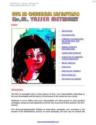 318
Professor Yasser Metwally
www.yassermetwally.com




 INDEX


                                                              MENINGITIS

                                                              ENCEPHALITIS

                                                              CHRONIC ENCEPHALITIS
                                                               OF RASMUSSEN AND
                                                               AGUILAR

                                                              HERPES SIMPLEX
                                                               ENCEPHALITIS

                                                              JAKOP-CREUTZFELDT

                                                              SUBACUTE SCLEROSING
                                                               PANENCEPHALITIS

                                                              BRAIN ABSCESS

                                                              EMPYEMA

                                                              RHEUMATIC CHOREA

                                                              REYE'S DISEASE

                                                              MULTIPLE SCLEROSIS




 MENINGITIS

 The EEG in meningitis shows various degrees of slow- wave abnormalities, depending on
 the type of meningitis and the degree of involvement of the central nervous system.

 Moderate to severe diffuse slow-wave abnormalities are often present in acute purulent
 meningitis, and paroxysmal epileptiform activity may be present in those patients who have
 seizures.

 The electroencephalographic findings in tuberculous meningitis vary according to the
 location of the inflammatory process. In basal meningitis, the EEG may be normal and




                                www.yassermetwally.com
 