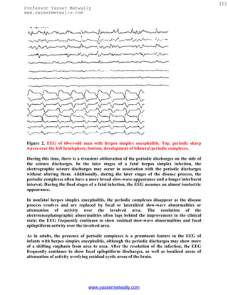 323
Professor Yasser Metwally
www.yassermetwally.com




 Figure 2. EEG of 68-yr-old man with herpes simplex encephalitis. Top, periodic sharp
 waves over the left hemisphere; bottom, development of bilateral periodic complexes.

 During this time, there is a transient obliteration of the periodic discharges on the side of
 the seizure discharges. In the later stages of a fatal herpes simplex infection, the
 electrographic seizure discharges may occur in association with the periodic discharges
 without altering them. Additionally, during the later stages of the disease process, the
 periodic complexes often have a more broad slow-wave appearance and a longer interburst
 interval. During the final stages of a fatal infection, the EEG assumes an almost isoelectric
 appearance.

 In nonfatal herpes simplex encephalitis, the periodic complexes disappear as the disease
 process resolves and are replaced by focal or lateralized slow-wave abnormalities or
 attenuation of activity over the involved area. The resolution of the
 electroencephalographic abnormalities often lags behind the improvement in the clinical
 state; the EEG frequently continues to show residual slow-wave abnormalities and focal
 epileptiform activity over the involved area.

 As in adults, the presence of periodic complexes is a prominent feature in the EEG of
 infants with herpes simplex encephalitis, although the periodic discharges may show more
 of a shifting emphasis from area to area. After the resolution of the infection, the EEG
 frequently continues to show focal epileptiform discharges, as well as localized areas of
 attenuation of activity overlying residual cystic areas of the brain.




                                 www.yassermetwally.com
 