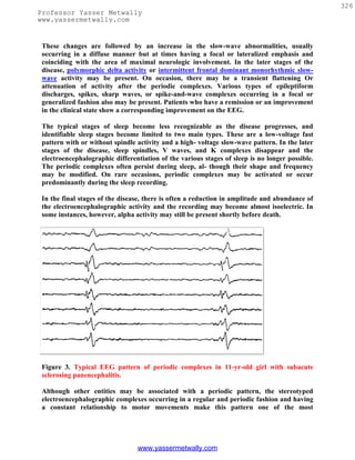 326
Professor Yasser Metwally
www.yassermetwally.com


 These changes are followed by an increase in the slow-wave abnormalities, usually
 occurring in a diffuse manner but at times having a focal or lateralized emphasis and
 coinciding with the area of maximal neurologic involvement. In the later stages of the
 disease, polymorphic delta activity or intermittent frontal dominant monorhythmic slow-
 wave activity may be present. On occasion, there may be a transient flattening Or
 attenuation of activity after the periodic complexes. Various types of epileptiform
 discharges, spikes, sharp waves, or spike-and-wave complexes occurring in a focal or
 generalized fashion also may be present. Patients who have a remission or an improvement
 in the clinical state show a corresponding improvement on the EEG.

 The typical stages of sleep become less recognizable as the disease progresses, and
 identifiable sleep stages become limited to two main types. These are a low-voltage fast
 pattern with or without spindle activity and a high- voltage slow-wave pattern. In the later
 stages of the disease, sleep spindles, V waves, and K complexes disappear and the
 electroencephalographic differentiation of the various stages of sleep is no longer possible.
 The periodic complexes often persist during sleep, al- though their shape and frequency
 may be modified. On rare occasions, periodic complexes may be activated or occur
 predominantly during the sleep recording.

 In the final stages of the disease, there is often a reduction in amplitude and abundance of
 the electroencephalographic activity and the recording may become almost isoelectric. In
 some instances, however, alpha activity may still be present shortly before death.




 Figure 3. Typical EEG pattern of periodic complexes in 11-yr-old girl with subacute
 sclerosing panencephalitis.

 Although other entities may be associated with a periodic pattern, the stereotyped
 electroencephalographic complexes occurring in a regular and periodic fashion and having
 a constant relationship to motor movements make this pattern one of the most




                                 www.yassermetwally.com
 