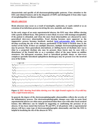 327
Professor Yasser Metwally
www.yassermetwally.com


 characteristic and specific of all electroencephalographic patterns. Close attention to the
 EEG and clinical features aid in the diagnosis of SSPE and distinguish it from other types
 of encephalopathies or disease entities.

 BRAIN ABSCESS

 Brain abscesses may occur as a result of meningitis, septicemia, or septic emboli or as an
 extension of an infectious process involving the ears, mastoids, and sinuses.

 In the early stages of an acute supratentorial abscess, the EEG may show diffuse slowing
 with a poorly defined focus. This pattern is more likely to occur with meningo-encephalitis,
 if the patient is obtunded, and when the more focal abnormalities are obscured by more
 generalized slow-wave abnormalities. Focal slowing becomes more apparent as the
 suppurative process becomes localized; marked focal polymorphic delta slowing can
 develop overlying the site of the abscess, particularly if the lesion is located close to the
 surface of the brain. If there are multiple abscesses, multiple electroencephalographic foci
 may be present. More generalized, intermittent, or shifting bursts of rhythmic slow waves
 (that is, a projected rhythm) also may be present; these bursts may be seen with a
 disturbance of the frontal lobe or as a secondary effect of the mass lesion on midline
 structures. On infrequent occasions, focal or lateralized periodic sharp- or slow-wave
 complexes (periodic lateralized epileptiform discharges) may be present over the involved
 area of the brain.




 Figure 4. EEG showing focal delta slowing over the right frontal region in a 9-yr-old boy
 with a right frontal abscess.

 In general, the degree of the electroencephalographic abnormalities reflects the severity of
 the inflammatory process. The electroencephalographic changes seen with an acute focal
 supratentorial abscess are often more pronounced than those seen with other focal cerebral
 lesions; this difference can be helpful in suggesting or confirming the presence of an
 abscess. It has been stated that between 90 and 95% of all patients with a supratentorial
 abscess will have some type of electroencephalographic abnormality and that the EEG is
 helpful in localizing the site of the abscess in 70%.




                                 www.yassermetwally.com
 