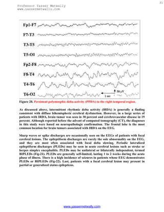 31
Professor Yasser Metwally
www.yassermetwally.com




 Figure 20. Persistent polymorphic delta activity (PPDA) in the right temporal region.

 As discussed above, intermittent rhythmic delta activity (lRDA) is generally a finding
 consistent with diffuse bihemispheric cerebral dysfunction. However, in a large series of
 patients with IRDA, brain tumor was seen in 30 percent and cerebrovascular disease in 19
 percent. Although reported before the advent of computed tomography (CT), the diagnoses
 in this study were based on neuropathologic confirmation. The frontal lobe is the most
 common location for brain tumors associated with IRDA on the EEG.

 Sharp waves or spike discharges are occasionally seen on the EEGs of patients with focal
 cerebral lesions. The epileptiform discharges are rarely the sole abnormality on the EEG,
 and they are most often associated with focal delta slowing. Periodic lateralized
 epileptiform discharges (PLEDs) may be seen in acute cerebral lesions such as stroke or
 herpes simplex encephalitis. PLEDs may be unilateral or bilaterally independent, termed
 BIPLEDs (Fig-21). PLEDs are generally self-limited, lasting 1 to 2 weeks during the acute
 phase of illness. There is a high incidence of seizures in patients whose EEG demonstrates
 PLEDs or BIPLEDs (Fig-22). Last, patients with a focal cerebral lesion may present in
 partial or generalized status epilepticus.




                                 www.yassermetwally.com
 