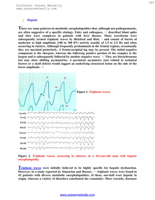 369
Professor Yasser Metwally
www.yassermetwally.com


       Hepatic

 There are some patterns in metabolic encephalopathies that, although not pathognomonic,
 are often suggestive of a specific etiology. Foley and colleagues, 18 described blunt spike
 and slow wave complexes in patients with liver disease. These waveforms were
 subsequently termed triphasic waves by Bickford and Butt, 6 and consist of bursts of
 moderate to high amplitude (100 to 300 liV) activity usually of 1.5 to 2.5 Hz and often
 occurring in clusters. Although frequently predominant in the frontal regions, occasionally
 they are maximal posteriorly. A fronto-occipital lag may be present. The initial negative
 component is the sharpest, whereas the following positive portion of the complex is the
 largest and is subsequently followed by another negative wave. 38 They are bisynchronous
 but may show shifting asymmetries. A persistent asymmetry (not related to technical
 factors or a skull defect) would suggest an underlying structural lesion on the side of the
 lower amplitude. 38




                                             Figure 1. Triphasic waves




 Figure 2. Triphasic waves, occurring in clusters, in a 44-year-old man with hepatic
 encephalopathy.

 Triphasic  waves were initially believed to be highly specific for hepatic dysfunction.
 However, in a study reported by Simsarian and Harner, 51 triphasic waves were found in
 42 patients with diverse metabolic encephalopathies; of these, one-half were hepatic in
 origin, whereas a variety of disorders constituted the remainder. More recently, Karnaze




                                 www.yassermetwally.com
 