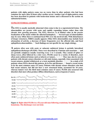 373
Professor Yasser Metwally
www.yassermetwally.com


 patients with alpha pattern coma was no worse than in other patients who had been
 comatose for more than 24 hours after cardiac arrest. Another type of alpha pattern coma
 has been described in patients with brain-stem lesions and is discussed in the section on
 subtentorial lesions.

 SUPRATENTORIAL LESIONS

 The EEG is usually markedly abnormal when coma is due to a supratentorial lesion. The
 abnormalities are greater with acute and rapidly expanding lesions rather than with
 chronic slow growing processes. The EEG, however, is of limited value in the precise
 localization of the lesion within the affected hemisphere. 37 Several types of abnormalities
 may be seen. Often there is continual focal PDA over the involved side. With disturbances
 of deeper structures, FIRDA usually appears. Other EEG abnormalities may include focal
 attenuation of activity, a decrease of faster frequencies over the affected side, and focal
 epileptiform abnormalities. 37 Such findings are not specific for any single etiology.

 A   pattern often seen with acute or subacute unilateral lesions is periodic lateralized
 epileptiform discharges (PLEDS). These were described by Chatrian and associates 12 and
 are periodic complexes usually recurring every 1 to 2 seconds. They consist of spikes or
 sharp waves, often followed by a slow wave. PLEDs occur in a variety of disorders, most
 often acute unilateral lesions such as infarcts or tumors. 12,15,35 They may also be seen in
 patients with chronic seizure disorders or old static lesions, especially when associated with
 recent seizures, alcohol withdrawal, or a toxic metabolic disorder. 12,15,35 In a study of 45
 patients whose EEGs showed this pattern, de la Paz and Brenner, 15 found a recent stroke
 to be the most common cause (15 cases). Patients with chronic seizure disorders who had
 had recent seizures, but did not have a new structural lesion, accounted for 10 cases,
 whereas tumors were the third most common cause (5 cases). PLEDs also occurred with
 disorders that more often produce diffuse disturbances, such as hypoxia (3 cases).




 Figure 4. Right sided PLEDs in a 52-year-old man following craniotomy for right subdural
 hematoma. The discharges were not ictal.




                                  www.yassermetwally.com
 