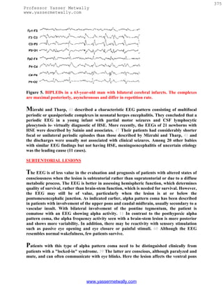 375
Professor Yasser Metwally
www.yassermetwally.com




 Figure 5. BIPLEDs in a 63-year-old man with bilateral cerebral infarcts. The complexes
 are maximal posteriorly, asynchronous and differ in repetition rate.

 Mizrahi and Tharp, 41 described a characteristic EEG pattern consisting of multifocal
 periodic or quasiperiodic complexes in neonatal herpes encephalitis. They concluded that a
 periodic EEG in a young infant with partial motor seizures and CSF lymphocytic
 pleocytosis is- virtually diagnostic of HSE. More recently, the EEGs of 21 newborns with
 HSE were described by Sainio and associates. 47 Their patients had considerably shorter
 focal or unilateral periodic episodes than those described by Mizrahi and Tharp, 41 and
 the discharges were usually not associated with clinical seizures. Among 20 other babies
 with similar EEG findings but not having HSE, meningoencephalitis of uncertain etiology
 was the leading cause (11 cases).

 SUBTENTORIAL LESIONS

 The EEG is of less value in the evaluation and prognosis of patients with altered states of
 consciousness when the lesion is subtentorial rather than supratentorial or due to a diffuse
 metabolic process. The EEG is better in assessing hemispheric function, which determines
 quality of survival, rather than brain-stem function, which is needed for survival. However,
 the EEG may still be of value, particularly when the lesion is at or below the
 pontomesencephalic junction. As indicated earlier, alpha pattern coma has been described
 in patients with involvement of the upper pons and caudal midbrain, usually secondary to a
 vascular insult. With bilateral involvement of the pontine tegmentum, the patient is
 comatose with an EEG showing alpha activity. 11 In contrast to the posthypoxic alpha
 pattern coma, the alpha frequency activity seen with a brain-stem lesion is more posterior
 and shows more variability. In addition, there may be reactivity with sensory stimulation
 such as passive eye opening and eye closure or painful stimuli. 60 Although the EEG
 resembles normal wakefulness, few patients survive.

 Patients  with this type of alpha pattern coma need to be distinguished clinically from
 patients with a "locked-in" syndrome. 39 The latter are conscious, although paralyzed and
 mute, and can often communicate with eye blinks. Here the lesion affects the ventral pons




                                 www.yassermetwally.com
 