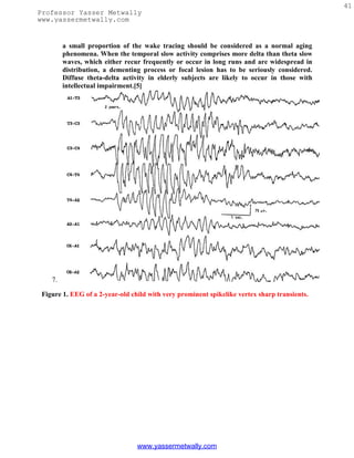 41
Professor Yasser Metwally
www.yassermetwally.com


         a small proportion of the wake tracing should be considered as a normal aging
         phenomena. When the temporal slow activity comprises more delta than theta slow
         waves, which either recur frequently or occur in long runs and are widespread in
         distribution, a dementing process or focal lesion has to be seriously considered.
         Diffuse theta-delta activity in elderly subjects are likely to occur in those with
         intellectual impairment.[5]




    7.

 Figure 1. EEG of a 2-year-old child with very prominent spikelike vertex sharp transients.




                                 www.yassermetwally.com
 