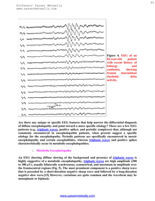 45
Professor Yasser Metwally
www.yassermetwally.com




                                                                     Figure 4. EEG of an
                                                                     82-year-old     patient
                                                                     with recent history of
                                                                     lethargy           and
                                                                     confusion,     showing
                                                                     frontal    intermittent
                                                                     rhythmic          delta
                                                                     activity.




 Are there any unique or specific EEG features that help narrow the differential diagnosis
 of diffuse encephalopathy and point toward a more specific etiology? There are a few EEG
 patterns (e.g., triphasic waves, positive spikes, and periodic complexes) that, although not
 commonly encountered in encephalopathic patients, when present suggest a specific
 etiology for the encephalopathy. Periodic patterns are specifically encountered in anoxic
 encephalopathy and certain encephalitides, whereas triphasic waves and positive spikes
 characteristically occur in metabolic encephalopathies.

           o   Metabolic Encephalopathy

 An EEG showing diffuse slowing of the background and presence of triphasic waves is
 highly suggestive of a metabolic encephalopathy. triphasic waves are high amplitude (200
 to 300 µV), usually bilaterally synchronous, symmetrical, and maximum in amplitude over
 the frontocentral regions (Fig. 5). The most prominent component is a positive sharp wave
 that is preceded by a short-duration negative sharp wave and followed by a long-duration
 negative slow wave.[15] However, variations are quite common and the waveform may be
 monophasic or biphasic.




                                 www.yassermetwally.com
 