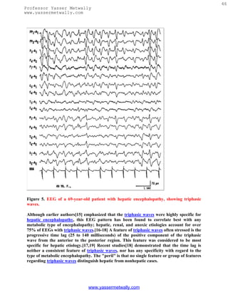 46
Professor Yasser Metwally
www.yassermetwally.com




 Figure 5. EEG of a 69-year-old patient with hepatic encephalopathy, showing triphasic
 waves.

 Although earlier authors[15] emphasized that the triphasic waves were highly specific for
 hepatic encephalopathy, this EEG pattern has been found to correlate best with any
 metabolic type of encephalopathy; hepatic, renal, and anoxic etiologies account for over
 75% of EEGs with triphasic waves.[16-18] A feature of triphasic waves often stressed is the
 progressive time lag (25 to 140 milliseconds) of the positive component of the triphasic
 wave from the anterior to the posterior region. This feature was considered to be most
 specific for hepatic etiology.[17,19] Recent studies[18] demonstrated that the time lag is
 neither a consistent feature of triphasic waves, nor has any specificity with regard to the
 type of metabolic encephalopathy. The "peril" is that no single feature or group of features
 regarding triphasic waves distinguish hepatic from nonhepatic cases.




                                 www.yassermetwally.com
 
