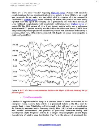 47
Professor Yasser Metwally
www.yassermetwally.com


 There are a few other "pearls" regarding triphasic waves. Patients with metabolic
 encephalopathies showing prominent triphasic wave activity in their EEG have an overall
 poor prognosis; in one series, over two thirds died in a matter of a few months.[20]
 Furthermore, triphasic waves occur essentially in adults; this pattern has been rarely
 reported below the age of 20 years.[21] This is particularly true with Reyes disease, an
 acute childhood encephalopathy with hepatic fatty infiltration, where triphasic waves are
 absent.[22] The EEG pattern of 14 to 6 per second, positive spikes are a well-known
 maturational EEG pattern normally seen in children in adolescence during NREM sleep.
 The presence of positive spike bursts in comatose patients with continuous delta activity is
 a unique, albeit rare, EEG pattern associated with hepatic or anoxic encephalopathy in
 children (Fig. 6).[23,24]




 Figure 6. EEG of a 16-year-old comatose patient with Reye's syndrome, showing 14 cps
 positive spikes.

           o   Toxic Encephalopathy

 Overdose of hypnotic-sedative drugs is a common cause of coma encountered in the
 emergency room; excessive beta activity is a prominent feature in the EEG over the
 anterior head regions. What is less well recognized is that with more severe intoxication,
 the fast activity assumes a slower frequency (usually 10 to 13 Hz), which is widespread but
 with anterior predominance. The presence of generalized theta-delta activity with
 superimposed alpha frequency activity is a unique encephalographic pattern highly
 characteristic of sedative drug intoxication (Fig. 7). In the absence of prominent slow




                                 www.yassermetwally.com
 