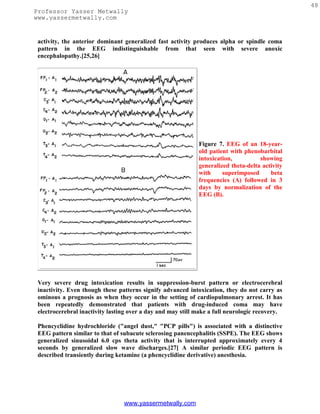 48
Professor Yasser Metwally
www.yassermetwally.com


 activity, the anterior dominant generalized fast activity produces alpha or spindle coma
 pattern in the EEG indistinguishable from that seen with severe anoxic
 encephalopathy.[25,26]




                                                             Figure 7. EEG of an 18-year-
                                                             old patient with phenobarbital
                                                             intoxication,          showing
                                                             generalized theta-delta activity
                                                             with     superimposed      beta
                                                             frequencies (A) followed in 3
                                                             days by normalization of the
                                                             EEG (B).




 Very severe drug intoxication results in suppression-burst pattern or electrocerebral
 inactivity. Even though these patterns signify advanced intoxication, they do not carry as
 ominous a prognosis as when they occur in the setting of cardiopulmonary arrest. It has
 been repeatedly demonstrated that patients with drug-induced coma may have
 electrocerebral inactivity lasting over a day and may still make a full neurologic recovery.

 Phencyclidine hydrochloride ("angel dust," "PCP pills") is associated with a distinctive
 EEG pattern similar to that of subacute sclerosing panencephalitis (SSPE). The EEG shows
 generalized sinusoidal 6.0 cps theta activity that is interrupted approximately every 4
 seconds by generalized slow wave discharges.[27] A similar periodic EEG pattern is
 described transiently during ketamine (a phencyclidine derivative) anesthesia.




                                 www.yassermetwally.com
 