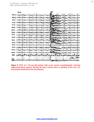 51
Professor Yasser Metwally
www.yassermetwally.com




 Figure 9. EEG of a 75-year-old patient with severe anoxic encephalopathy, showing
 suppression-burst pattern. During the burst activity there is opening of the eyes; eye
 movements monitored in the last channel.




                                www.yassermetwally.com
 