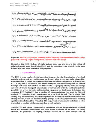 52
Professor Yasser Metwally
www.yassermetwally.com




 Figure 10. EEG of a 77-year-old comatose patient following cardiopulmonary arrest 4 days
 previously, showing "alpha coma pattern." Patient died after 2 days.

 Remember that EEG findings of alpha pattern coma are also seen in the setting of
 sedative/hypnotic drug intoxication[25,35] and in association with intrinsic brain stem
 lesions[36] with a much more favorable prognosis.

           o   Cerebral Death

 The EEG is being employed with increasing frequency for the determination of cerebral
 death in patients with irreversible coma, particularly when organs have to be salvaged for
 transplantation. It cannot be overemphasized that the absence of cerebral activity on the
 EEG is only one of the criteria, and should always be considered along with the clinical
 findings and blood flow studies for brain death. To properly identify very-low-voltage
 cerebral activity, to distinguish physiological or instrumental artifacts, and to eliminate the
 possibility of errors through malfunctioning equipment or inadequate techniques, the
 American EEG Society[37] has a number of recommendations that must be followed
 during EEG recordings in all cases of suspected brain death. In such "flat" tracings, EEG
 activity may be obscured by very-low-amplitude fast activity due to sustained contraction
 of scalp muscles, which can be eliminated by giving a short-acting neuromuscular blocking
 agent (succinylcholine, 20 to 40 mg IV). This step, which is very easy to undertake, is often
 overlooked to obtain a satisfactory recording in such patients.

 A single EEG and a 6- to 12-hour clinical observation after an unequivocal acute cerebral
 insult are minimum requirements for brain death evaluation in an adult. In young
 children, the guidelines are slightly different because of the more difficult task of



                                  www.yassermetwally.com
 