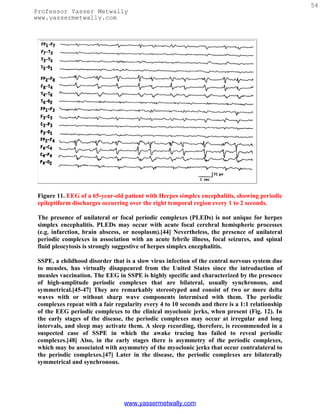 54
Professor Yasser Metwally
www.yassermetwally.com




 Figure 11. EEG of a 65-year-old patient with Herpes simplex encephalitis, showing periodic
 epileptiform discharges occurring over the right temporal region every 1 to 2 seconds.

 The presence of unilateral or focal periodic complexes (PLEDs) is not unique for herpes
 simplex encephalitis. PLEDs may occur with acute focal cerebral hemispheric processes
 (e.g. infarction, brain abscess, or neoplasm).[44] Nevertheless, the presence of unilateral
 periodic complexes in association with an acute febrile illness, focal seizures, and spinal
 fluid pleocytosis is strongly suggestive of herpes simplex encephalitis.

 SSPE, a childhood disorder that is a slow virus infection of the central nervous system due
 to measles, has virtually disappeared from the United States since the introduction of
 measles vaccination. The EEG in SSPE is highly specific and characterized by the presence
 of high-amplitude periodic complexes that are bilateral, usually synchronous, and
 symmetrical.[45-47] They are remarkably stereotyped and consist of two or more delta
 waves with or without sharp wave components intermixed with them. The periodic
 complexes repeat with a fair regularity every 4 to 10 seconds and there is a 1:1 relationship
 of the EEG periodic complexes to the clinical myoclonic jerks, when present (Fig. 12). In
 the early stages of the disease, the periodic complexes may occur at irregular and long
 intervals, and sleep may activate them. A sleep recording, therefore, is recommended in a
 suspected case of SSPE in which the awake tracing has failed to reveal periodic
 complexes.[48] Also, in the early stages there is asymmetry of the periodic complexes,
 which may be associated with asymmetry of the myoclonic jerks that occur contralateral to
 the periodic complexes.[47] Later in the disease, the periodic complexes are bilaterally
 symmetrical and synchronous.




                                 www.yassermetwally.com
 