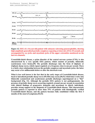 55
Professor Yasser Metwally
www.yassermetwally.com




 Figure 12. EEG of a 16-year-old patient with subacute sclerosing panencephalitis, showing
 high-amplitude generalized periodic complexes repeating at intervals of 8 to 10 seconds and
 accompanied by eye jerks and myoclonic jerks of the upper extremities monitored on the
 last two channels.

 Creutzfeldt-Jakob disease, a prion disorder of the central nervous system (CNS), is also
 characterized by a very specific EEG pattern, which consists of periodic, bilaterally
 synchronous wave forms.[49] The periodic discharges take the form of diphasic or
 triphasic sharp waves, which repeat regularly at a frequency close to one per second. There
 is a fairly close relationship between the periodic complexes and myoclonic jerks; the latter
 may occur a few milliseconds before or after the electrical event.

 What is less well known is the fact that in the early stages of Creutzfeldt-Jakob disease,
 focal or lateralized periodic sharp waves (PLEDs) may occur,[50,51] which later evolve into
 bilaterally symmetrical and synchronous periodic discharges superimposed on a "flat"
 background (Fig. 13). Although the periodic EEG pattern is not pathognomonic, the
 presence of periodic sharp waves occurring regularly around one per second, in association
 with clinical findings of progressive dementia and myoclonus in elderly individuals,
 provides strong support to the diagnosis of Creutzfeldt-Jakob disease. This characteristic
 periodic pattern is reported in more than 75% of patients with histologically verified
 Creutzfeldt-Jakob disease, and the pattern becomes fully established within the first 3
 months of the onset of symptoms.[52,53]




                                 www.yassermetwally.com
 