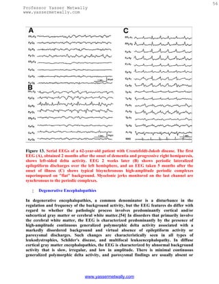 56
Professor Yasser Metwally
www.yassermetwally.com




 Figure 13. Serial EEGs of a 62-year-old patient with Creutzfeldt-Jakob disease. The first
 EEG (A), obtained 2 months after the onset of dementia and progressive right hemiparesis,
 shows left-sided delta activity. EEG 2 weeks later (B) shows periodic lateralized
 epileptiform discharges over the left hemisphere, and an EEG taken 5 months after the
 onset of illness (C) shows typical bisynchronous high-amplitude periodic complexes
 superimposed on "flat" background. Myoclonic jerks monitored on the last channel are
 synchronous to the periodic complexes.

       Degenerative Encephalopathies

 In degenerative encephalopathies, a common denominator is a disturbance in the
 regulation and frequency of the background activity, but the EEG features do differ with
 regard to whether the pathologic process involves predominantly cortical and/or
 subcortical gray matter or cerebral white matter.[54] In disorders that primarily involve
 the cerebral white matter, the EEG is characterized predominantly by the presence of
 high-amplitude continuous generalized polymorphic delta activity associated with a
 markedly disordered background and virtual absence of epileptiform activity or
 paroxysmal discharges. Such changes are characteristically seen in all types of
 leukodystrophies, Schilder's disease, and multifocal leukoencephalopathy. In diffuse
 cortical gray matter encephalopathies, the EEG is characterized by abnormal background
 activity that is slow, irregular, and low in amplitude. There is minimal continuous
 generalized polymorphic delta activity, and paroxysmal findings are usually absent or




                                www.yassermetwally.com
 