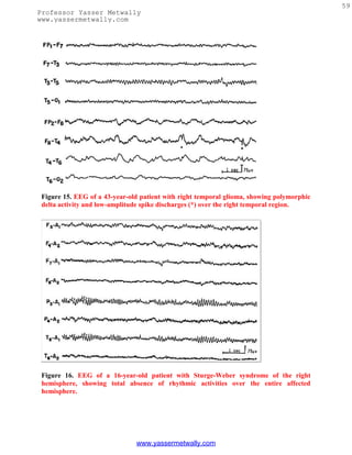 59
Professor Yasser Metwally
www.yassermetwally.com




 Figure 15. EEG of a 43-year-old patient with right temporal glioma, showing polymorphic
 delta activity and low-amplitude spike discharges (*) over the right temporal region.




 Figure 16. EEG of a 16-year-old patient with Sturge-Weber syndrome of the right
 hemisphere, showing total absence of rhythmic activities over the entire affected
 hemisphere.




                               www.yassermetwally.com
 