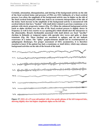 60
Professor Yasser Metwally
www.yassermetwally.com


 Certainly, attenuation, disorganization, and slowing of the background activity on the side
 of the focal cerebral lesion and presence of PDA are EEG hallmarks of a focal cerebral
 process. Less often, the amplitude of the background activity may be higher on the side of
 the focal cerebral lesion,[65] which may lead to an erroneous interpretation of the side of
 the lesion. Such increase in the amplitude of the background activity is encountered with
 cerebral infarcts that have "healed," with skull defect related to previous craniotomy or in
 patients with slowly progressive tumors (Fig. 17). Often the enhanced background activity
 (such as alpha rhythm) over the side of the focal cerebral process is slightly slower in
 frequency as well as less reactive to eye opening,[63] which should alert the interpreter to
 the abnormality. Breach rhythms[66] associated with skull defects are focal "mu-like"
 rhythms in Rolandic or temporal region with sporadic slow waves and spiky or sharp
 transients (Fig. 18). These rhythms are unrelated to epilepsy and do not indicate
 recurrence of a tumor. The "spiky" grapho-elements should not be overinterpreted as
 epileptogenic discharges. For proper assessment of EEG asymmetries, it is therefore
 essential to know if the patient has had a craniotomy or skull defect, which may enhance
 background activities on the side of the breach of the skull.




 Figure 17. EEG of a 47-year-old patient with a low-grade glioma of the left temporal lobe,
 showing slightly slow but higher amplitude alpha on the left side.




                                 www.yassermetwally.com
 