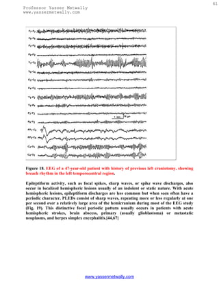 61
Professor Yasser Metwally
www.yassermetwally.com




 Figure 18. EEG of a 47-year-old patient with history of previous left craniotomy, showing
 breach rhythm in the left temporocentral region.

 Epileptiform activity, such as focal spikes, sharp waves, or spike wave discharges, also
 occur in localized hemispheric lesions usually of an indolent or static nature. With acute
 hemispheric lesions, epileptiform discharges are less common but when seen often have a
 periodic character. PLEDs consist of sharp waves, repeating more or less regularly at one
 per second over a relatively large area of the hemicranium during most of the EEG study
 (Fig. 19). This distinctive focal periodic pattern usually occurs in patients with acute
 hemispheric strokes, brain abscess, primary (usually glioblastoma) or metastatic
 neoplasms, and herpes simplex encephalitis.[44,67]




                                www.yassermetwally.com
 