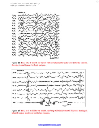 72
Professor Yasser Metwally
www.yassermetwally.com




 Figure 22. EEG of a 6-month-old infant with developmental delay and infantile spasms,
 showing typical hypsarrhythmic pattern.




 Figure 23. EEG of a 5-month-old infant, showing electrodecremental response during an
 infantile spasm monitored on the last channel.




                               www.yassermetwally.com
 