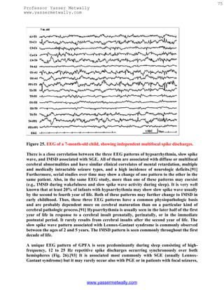 75
Professor Yasser Metwally
www.yassermetwally.com




 Figure 25. EEG of a 7-month-old child, showing independent multifocal spike discharges.

 There is a close correlation between the three EEG patterns of hypsarrhythmia, slow spike
 wave, and IMSD associated with SGE. All of them are associated with diffuse or multifocal
 cerebral abnormalities and have similar clinical correlates of mental retardation, multiple
 and medically intractable seizure types, and a high incidence of neurologic deficits.[91]
 Furthermore, serial studies over time may show a change of one pattern to the other in the
 same patient. Also, in the same EEG study, more than one of these patterns may coexist
 (e.g., IMSD during wakefulness and slow spike wave activity during sleep). It is very well
 known that at least 20% of infants with hypsarrhythmia may show slow spike wave usually
 by the second to fourth year of life. Both of these patterns may further change to IMSD in
 early childhood. Thus, these three EEG patterns have a common physiopathologic basis
 and are probably dependent more on cerebral maturation than on a particular kind of
 cerebral pathologic process.[91] Hypsarrhythmia is usually seen in the later half of the first
 year of life in response to a cerebral insult prenatally, perinatally, or in the immediate
 postnatal period. It rarely results from cerebral insults after the second year of life. The
 slow spike wave pattern associated with Lennox-Gastaut syndrome is commonly observed
 between the ages of 2 and 5 years. The IMSD pattern is seen commonly throughout the first
 decade of life.

 A unique EEG pattern of GPFA is seen predominantly during sleep consisting of high-
 frequency, 12 to 25 Hz repetitive spike discharges occurring synchronously over both
 hemispheres (Fig. 26).[93] It is associated most commonly with SGE (usually Lennox-
 Gastaut syndrome) but it may rarely occur also with PGE or in patients with focal seizures,




                                  www.yassermetwally.com
 