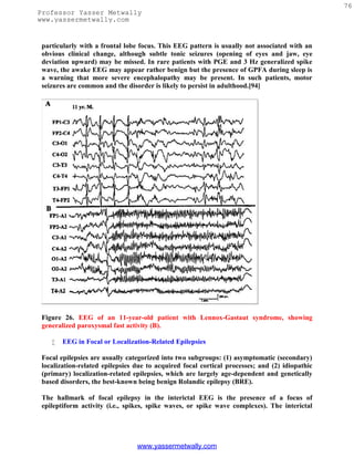 76
Professor Yasser Metwally
www.yassermetwally.com


 particularly with a frontal lobe focus. This EEG pattern is usually not associated with an
 obvious clinical change, although subtle tonic seizures (opening of eyes and jaw, eye
 deviation upward) may be missed. In rare patients with PGE and 3 Hz generalized spike
 wave, the awake EEG may appear rather benign but the presence of GPFA during sleep is
 a warning that more severe encephalopathy may be present. In such patients, motor
 seizures are common and the disorder is likely to persist in adulthood.[94]




 Figure 26. EEG of an 11-year-old patient with Lennox-Gastaut syndrome, showing
 generalized paroxysmal fast activity (B).

       EEG in Focal or Localization-Related Epilepsies

 Focal epilepsies are usually categorized into two subgroups: (1) asymptomatic (secondary)
 localization-related epilepsies due to acquired focal cortical processes; and (2) idiopathic
 (primary) localization-related epilepsies, which are largely age-dependent and genetically
 based disorders, the best-known being benign Rolandic epilepsy (BRE).

 The hallmark of focal epilepsy in the interictal EEG is the presence of a focus of
 epileptiform activity (i.e., spikes, spike waves, or spike wave complexes). The interictal




                                 www.yassermetwally.com
 