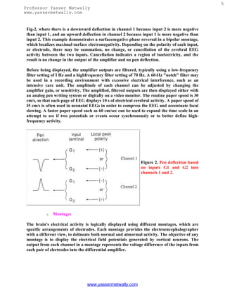 5
Professor Yasser Metwally
www.yassermetwally.com


 Fig-2, where there is a downward deflection in channel 1 because input 2 is more negative
 than input 1, and an upward deflection in channel 2 because input 1 is more negative than
 input 2. This example demonstrates a surfacenegative phase reversal in a bipolar montage,
 which localizes maximal surface electronegativity. Depending on the polarity of each input,
 or electrode, there may be summation, no change, or cancellation of the cerebral EEG
 activity between the two inputs. Cancellation indicates a region of isoelectricity, and the
 result is no change in the output of the amplifier and no pen deflection.

 Before being displayed, the amplifier outputs are filtered, typically using a low-frequency
 filter setting of I Hz and a highfrequency filter setting of 70 Hz. A 60-Hz "notch" filter may
 be used in a recording environment with excessive electrical interference, such as an
 intensive care unit. The amplitude of each channel can be adjusted by changing the
 amplifier gain, or sensitivity. The amplified, filtered outputs are then displayed either with
 an analog pen writing system or digitally on a video monitor. The routine paper speed is 30
 cm/s, so that each page of EEG displays 10 s of electrical cerebral activity. A paper speed of
 I5 cm/s is often used in neonatal EEGs in order to compress the EEG and accentuate focal
 slowing. A faster paper speed such as 60 cm/sec can be used to expand the time scale in an
 attempt to see if two potentials or events occur synchronously or to better define high-
 frequency activity.




                                                               Figure 2. Pen deflection based
                                                               on inputs G1 and G2 into
                                                               channels 1 and 2.




           o   Montages

 The brain's electrical activity is logically displayed using different montages, which are
 specific arrangements of electrodes. Each montage provides the electroencephalographer
 with a different view, to delineate both normal and abnormal activity. The objective of any
 montage is to display the electrical field potentials generated by cortical neurons. The
 output from each channel in a montage represents the voltage difference of the inputs from
 each pair of electrodes into the differential amplifier.




                                  www.yassermetwally.com
 