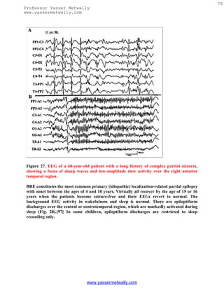 78
Professor Yasser Metwally
www.yassermetwally.com




 Figure 27. EEG of a 68-year-old patient with a long history of complex partial seizures,
 showing a focus of sharp waves and low-amplitude slow activity over the right anterior
 temporal region.

 BRE constitutes the most common primary (idiopathic) localization-related partial epilepsy
 with onset between the ages of 4 and 10 years. Virtually all recover by the age of 15 or 16
 years when the patients become seizure-free and their EEGs revert to normal. The
 background EEG activity in wakefulness and sleep is normal. There are epileptiform
 discharges over the central or centrotemporal region, which are markedly activated during
 sleep (Fig. 28).[97] In some children, epileptiform discharges are restricted to sleep
 recording only.




                                 www.yassermetwally.com
 