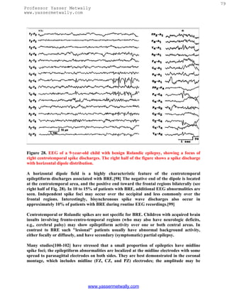 79
Professor Yasser Metwally
www.yassermetwally.com




 Figure 28. EEG of a 9-year-old child with benign Rolandic epilepsy, showing a focus of
 right centrotemporal spike discharges. The right half of the figure shows a spike discharge
 with horizontal dipole distribution.

 A horizontal dipole field is a highly characteristic feature of the centrotemporal
 epileptiform discharges associated with BRE.[98] The negative end of the dipole is located
 at the centrotemporal area, and the positive end toward the frontal regions bilaterally (see
 right half of Fig. 28). In 10 to 15% of patients with BRE, additional EEG abnormalities are
 seen. Independent spike foci may occur over the occipital and less commonly over the
 frontal regions. Interestingly, bisynchronous spike wave discharges also occur in
 approximately 10% of patients with BRE during routine EEG recordings.[99]

 Centrotemporal or Rolandic spikes are not specific for BRE. Children with acquired brain
 insults involving fronto-centro-temporal regions (who may also have neurologic deficits,
 e.g., cerebral palsy) may show epileptiform activity over one or both central areas. In
 contrast to BRE such "lesional" patients usually have abnormal background activity,
 either focally or diffusely, and have secondary (symptomatic) partial epilepsy.

 Many studies[100-102] have stressed that a small proportion of epileptics have midline
 spike foci; the epileptiform abnormalities are localized at the midline electrodes with some
 spread to parasagittal electrodes on both sides. They are best demonstrated in the coronal
 montage, which includes midline (FZ, CZ, and PZ) electrodes; the amplitude may be




                                 www.yassermetwally.com
 