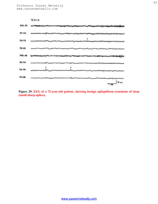 83
Professor Yasser Metwally
www.yassermetwally.com




 Figure 29. EEG of a 72-year-old patient, showing benign epileptiform transients of sleep
 (small sharp spikes).




                                www.yassermetwally.com
 
