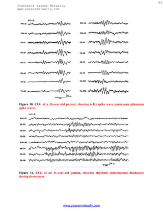 84
Professor Yasser Metwally
www.yassermetwally.com




 Figure 30. EEG of a 26-year-old patient, showing 6 Hz spike wave paroxysms (phantom
 spike wave).




 Figure 31. EEG of an 11-year-old patient, showing rhythmic midtemporal discharges
 during drowsiness.




                              www.yassermetwally.com
 