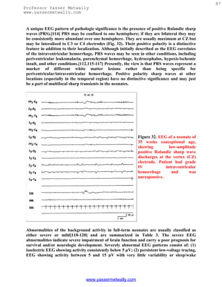 87
Professor Yasser Metwally
www.yassermetwally.com


 A unique EEG pattern of pathologic significance is the presence of positive Rolandic sharp
 waves (PRS).[114] PRS may be confined to one hemisphere; if they are bilateral they may
 be consistently more abundant over one hemisphere. They are usually maximum at CZ but
 may be lateralized to C3 or C4 electrodes (Fig. 32). Their positive polarity is a distinctive
 feature in addition to their localization. Although initially described as the EEG correlates
 of the intraventricular hemorrhage, PRS waves may be seen in other conditions, including
 periventricular leukomalacia, parenchymal hemorrhage, hydrocephalus, hypoxic/ischemic
 insult, and other conditions.[112,115-117] Presently, the view is that PRS waves represent a
 marker of different white matter lesions rather than being specific for
 periventricular/intraventricular hemorrhage. Positive polarity sharp waves at other
 locations (especially in the temporal region) have no distinctive significance and may just
 be a part of multifocal sharp transients in the neonates.




                                                              Figure 32. EEG of a neonate of
                                                              35 weeks conceptional age,
                                                              showing          low-amplitude
                                                              positive Rolandic sharp wave
                                                              discharges at the vertex (CZ)
                                                              electrode. Patient had grade
                                                              IV             intraventricular
                                                              hemorrhage        and      was
                                                              unresponsive.




 Abnormalities of the background activity in full-term neonates are usually classified as
 either severe or mild[118-120] and are summarized in Table 3. The severe EEG
 abnormalities indicate severe impairment of brain function and carry a poor prognosis for
 survival and/or neurologic development. Severely abnormal EEG patterns consist of: (1)
 isoelectric EEG showing activity consistently below 5 µV; (2) persistent low-voltage tracing,
 EEG showing activity between 5 and 15 µV with very little variability or sleep/wake




                                 www.yassermetwally.com
 
