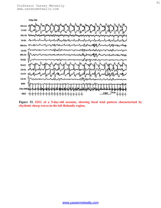 91
Professor Yasser Metwally
www.yassermetwally.com




 Figure 33. EEG of a 5-day-old neonate, showing focal ictal pattern characterized by
 rhythmic sharp waves in the left Rolandic region.




                              www.yassermetwally.com
 